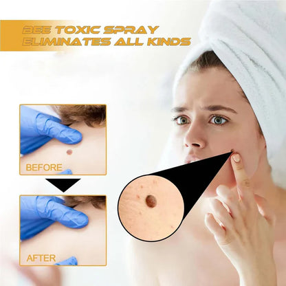 Bee Venom Skin Tag & Wart Remover Spray - Rs.1199/-