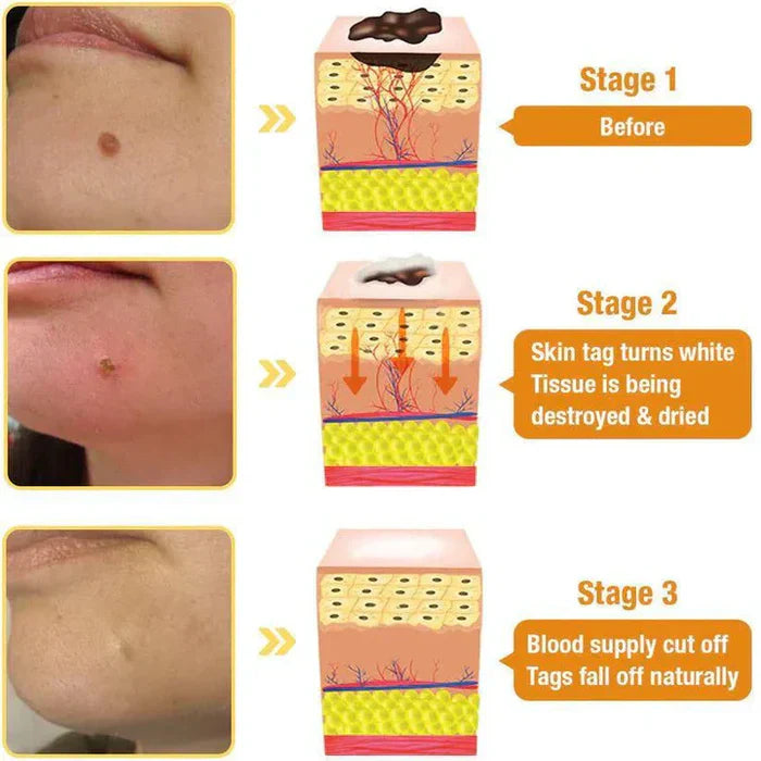 Bee Venom Skin Tag & Wart Remover Spray - Rs.1199/-