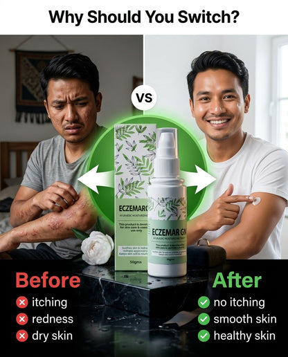 Eczemar ON – Ayurvedic Psoriasis & Eczema Moisturizing Cream